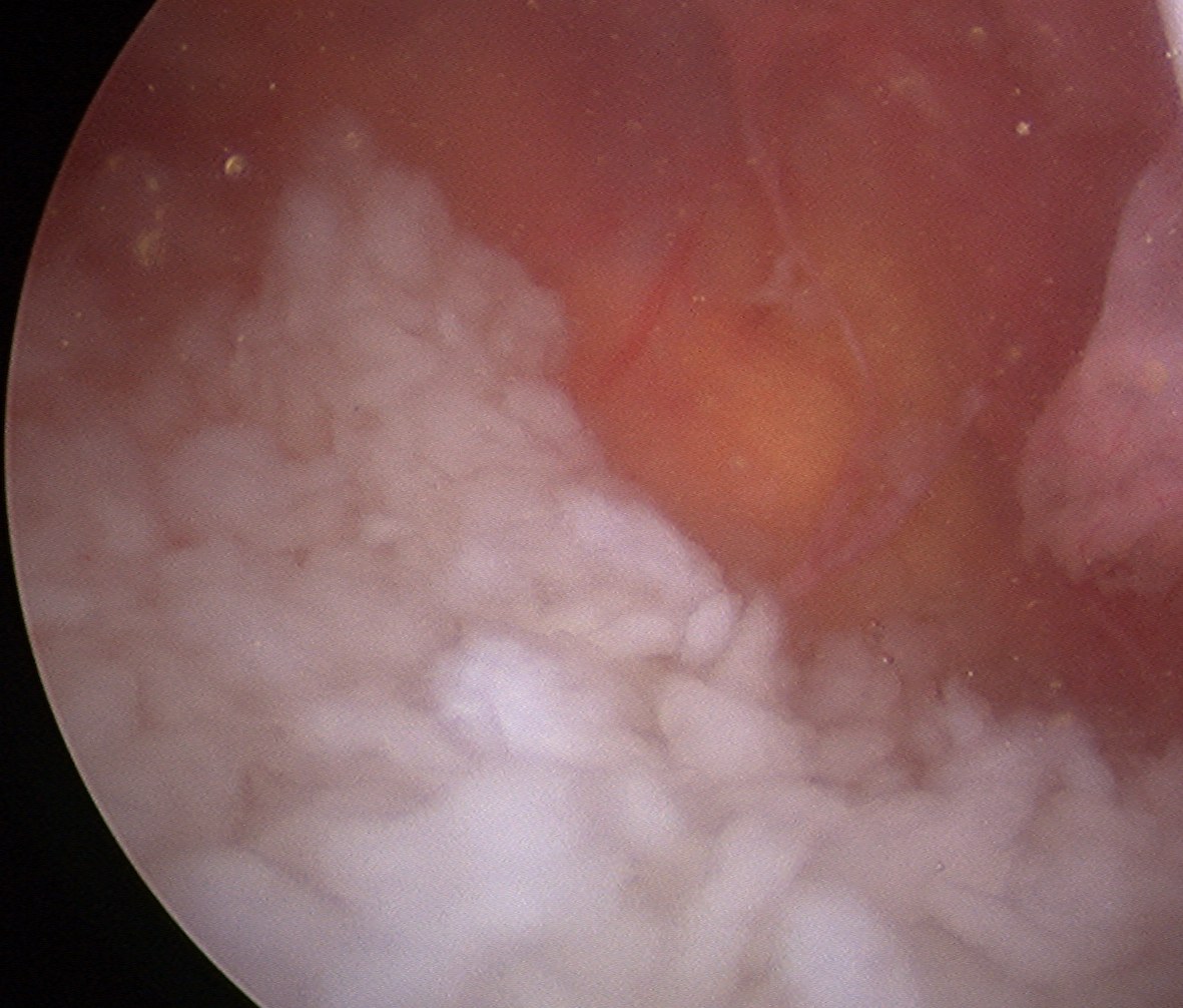 Knee Chondromatosis